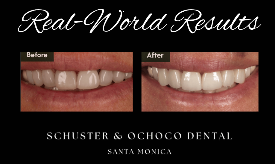 Before and after photo of patient's shortened, discolored front teeth corrected with porcelain veneers for a fuller, natural-looking smile in Santa Monica