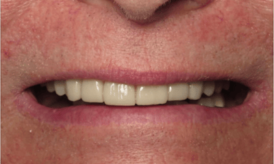 After treatment - All-On-X Implant Denture