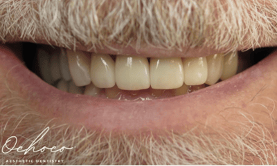 After treatment - Ceramic Crowns