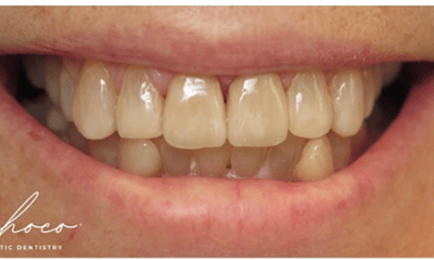 After treatment - Ceramic Crowns