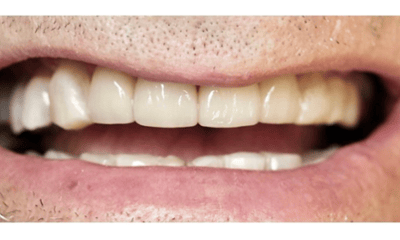 After treatment - Ceramic Crowns