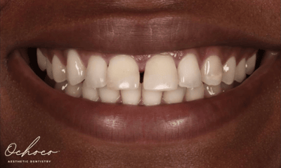 After treatment - Composite Bonding