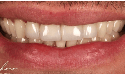 After treatment - Porcelain Veneers