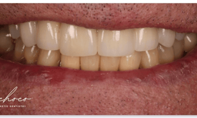 After treatment - Porcelain Veneers