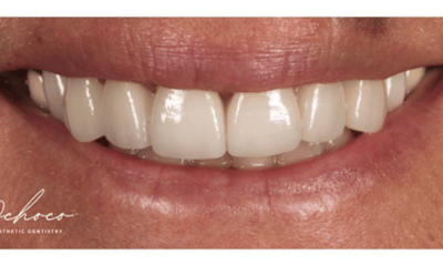 After treatment - Porcelain Veneers