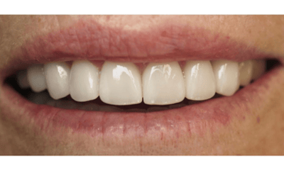After treatment - Porcelain Veneers