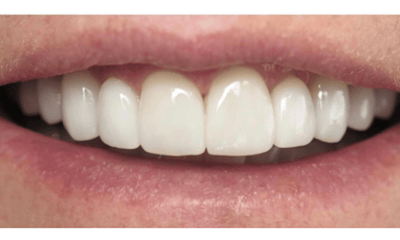After treatment - Porcelain Veneers