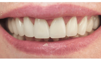 After treatment - Porcelain Veneers