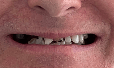 Before treatment - All-On-X Implant Denture