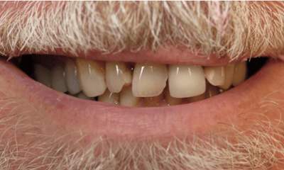 Before treatment - Ceramic Crowns