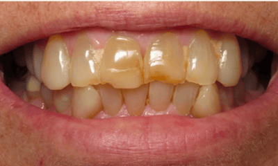 Before treatment - Ceramic Crowns