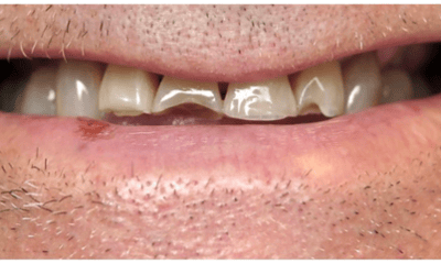 Before treatment - Ceramic Crowns