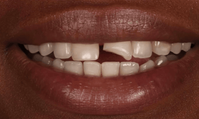 Before treatment - Composite Bonding