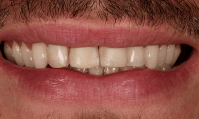 Before treatment - Porcelain Veneers
