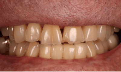 Before treatment - Porcelain Veneers