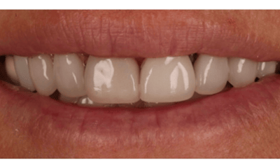 Before treatment - Porcelain Veneers