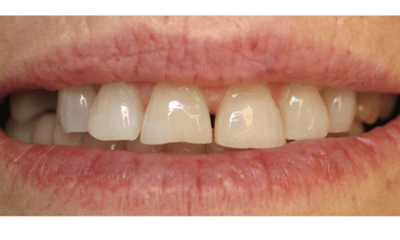 Before treatment - Porcelain Veneers