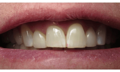 Before treatment - Porcelain Veneers
