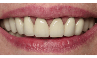 Before treatment - Porcelain Veneers