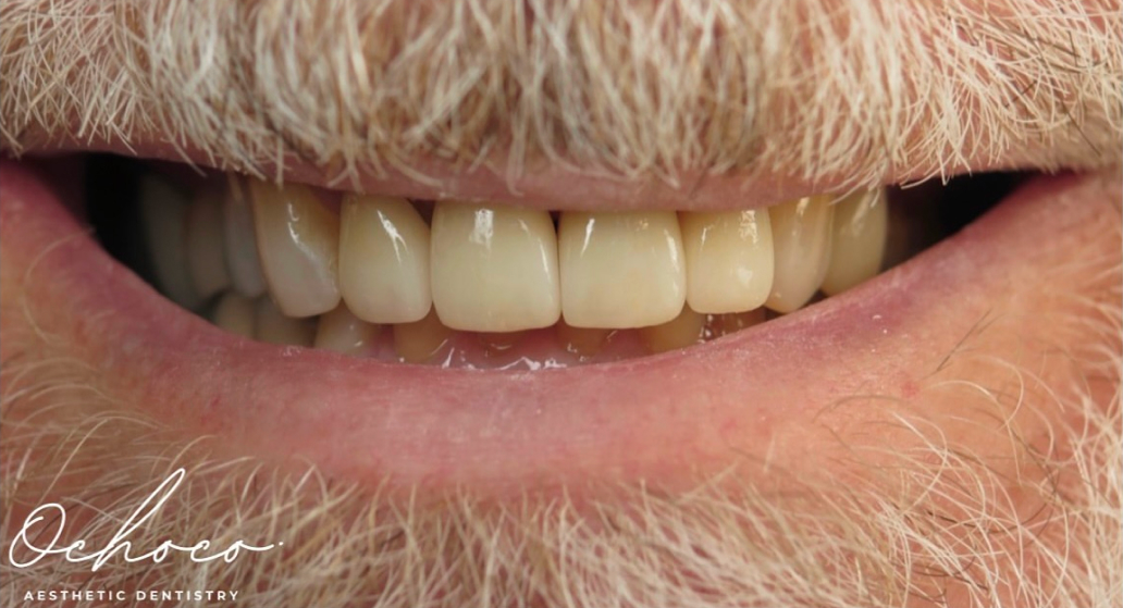 A second patient smile after treatment