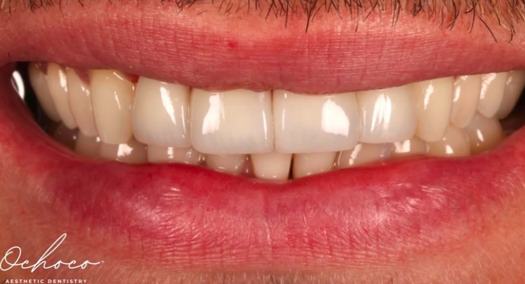 Patient smile after treatment at SCHUSTER AND OCHOCO DENTAL