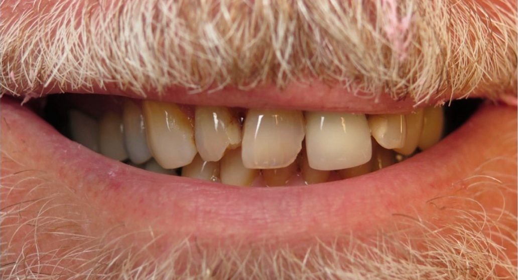 A second patient smile before treatment