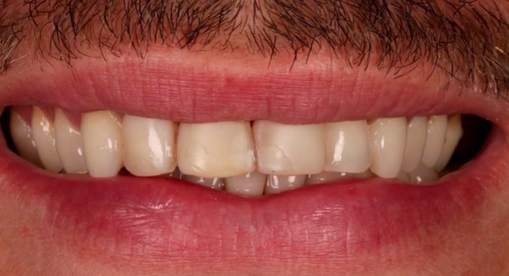Patient smile before treatment at SCHUSTER AND OCHOCO DENTAL